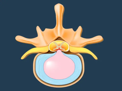 Herniated disc