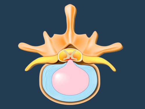 herniated disc