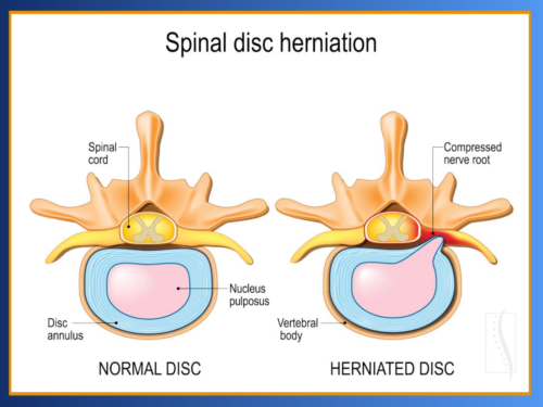 Normal and herniated spinal disc